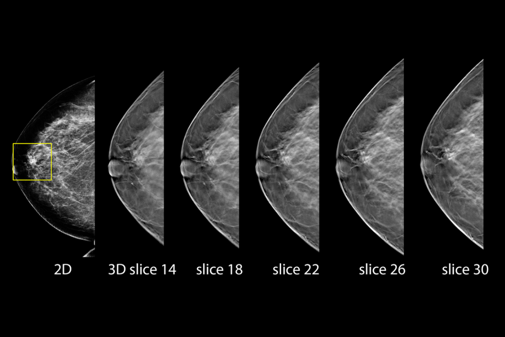 Clinical images of breast scan with suspicious Lesion