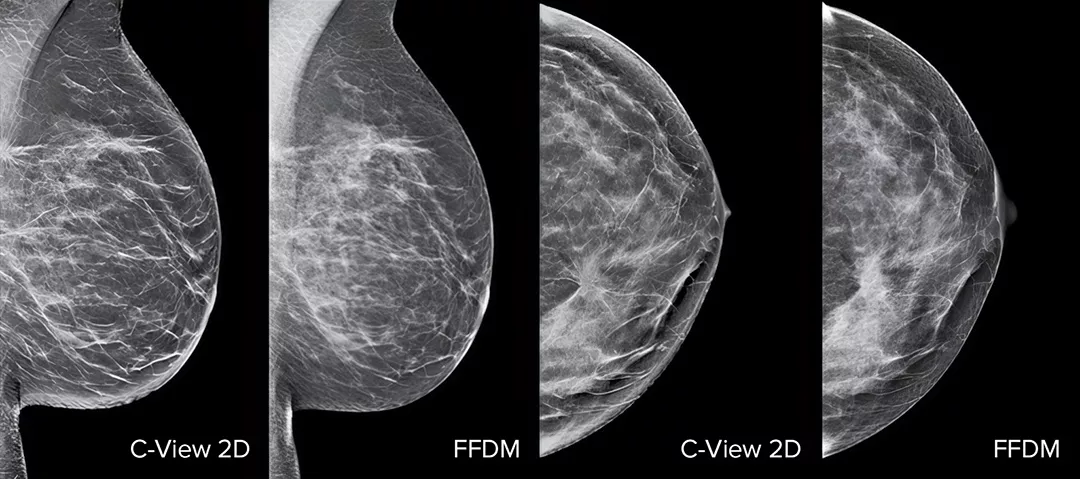 Images of breast x-ray